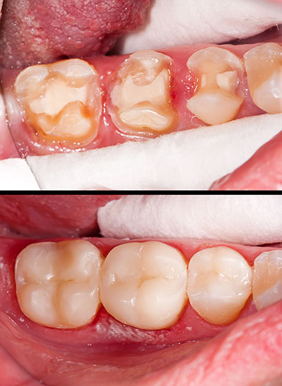 M. Derek Davis, DDS | Dental Fillings, Teeth Whitening and Preventative Program