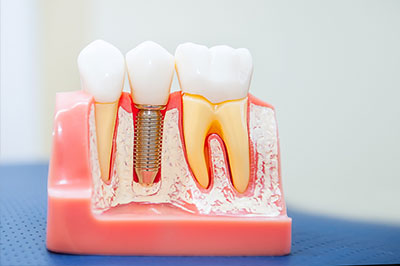 M. Derek Davis, DDS | Root Canals, Dental Fillings and Dentures