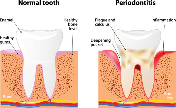 M. Derek Davis, DDS | Extractions, Ceramic Crowns and Periodontal Treatment