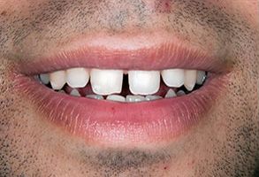 M. Derek Davis, DDS | Cosmetic Dentistry, Veneers and Teeth Whitening